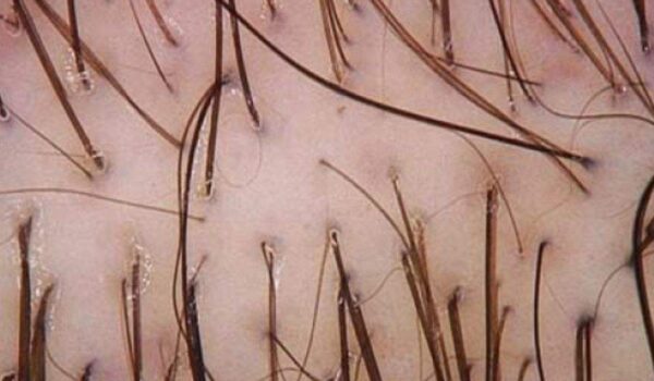 alopecia_androgenetica (2)