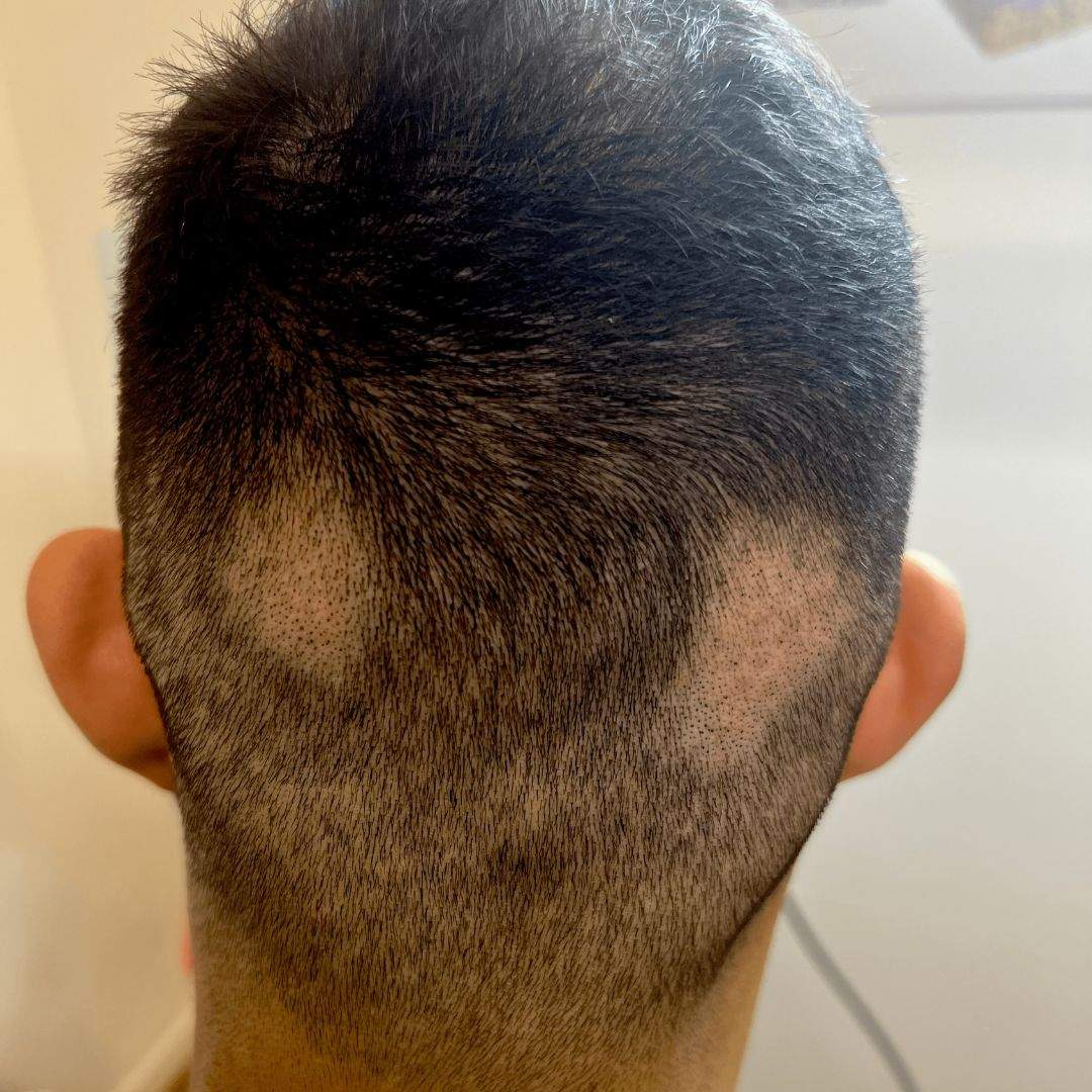 alopecia_areata