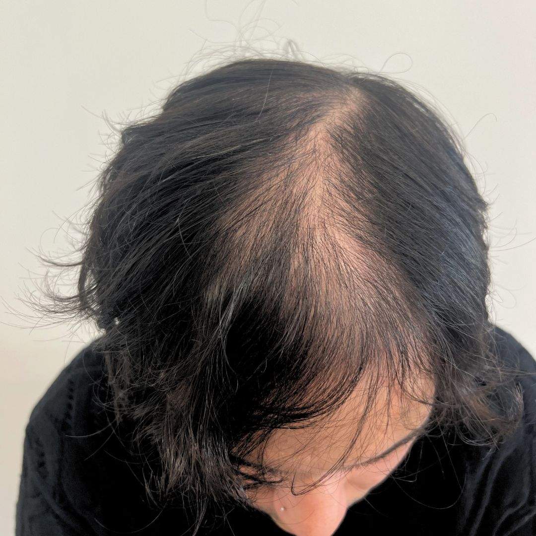 caduta_dei_capelli_uomo