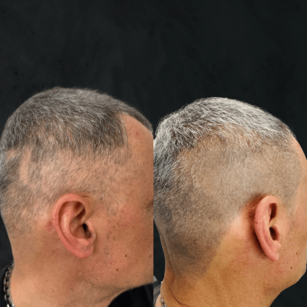 ALOPECIA AREATA (2)