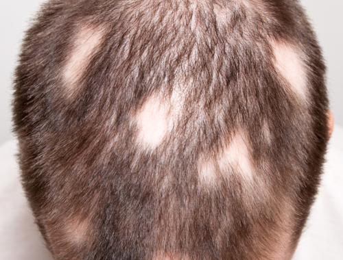 alopecia areata (2)