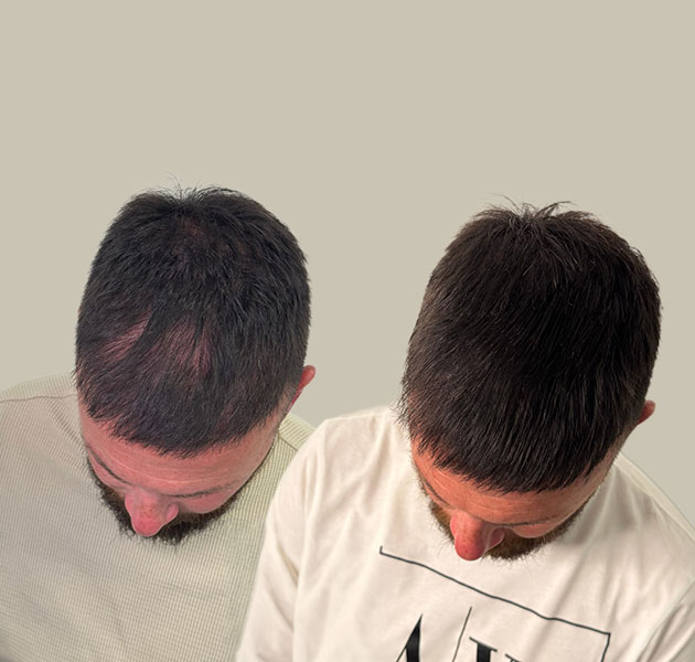 tricholos-prima-dopo-1