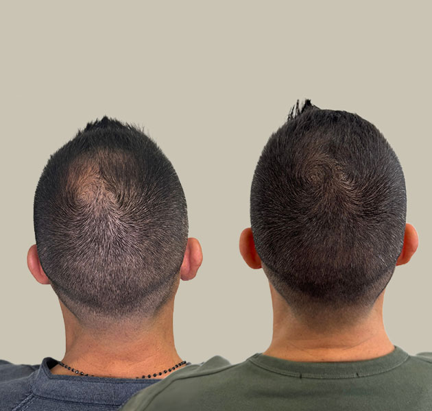 tricholos-prima-dopo-2