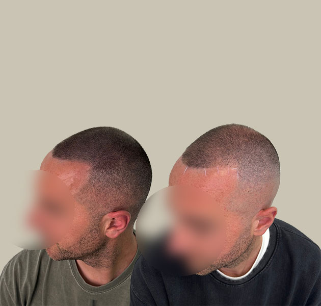 tricholos-prima-dopo-3