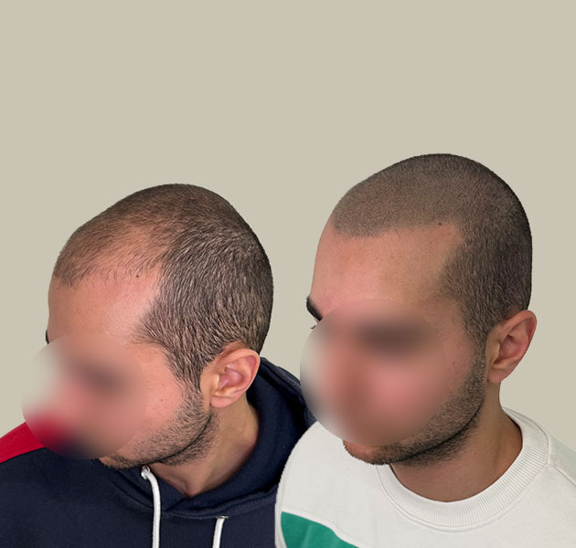 tricholos-prima-dopo-4